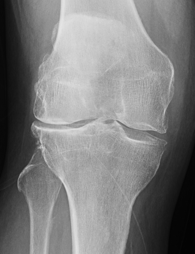 Lateral compartment OA