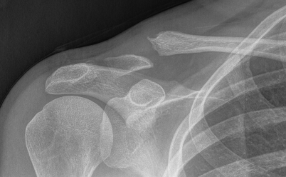 Lateral clavicle nonunion