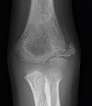 Lateral condyle nonunion