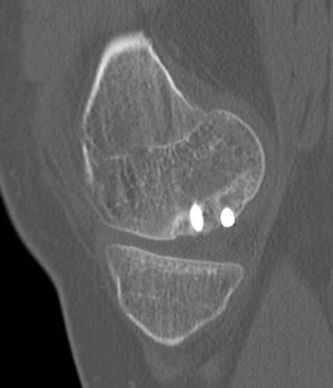 CT healing OCD 2