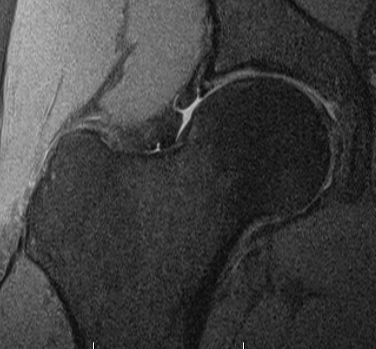 MRI coronal 