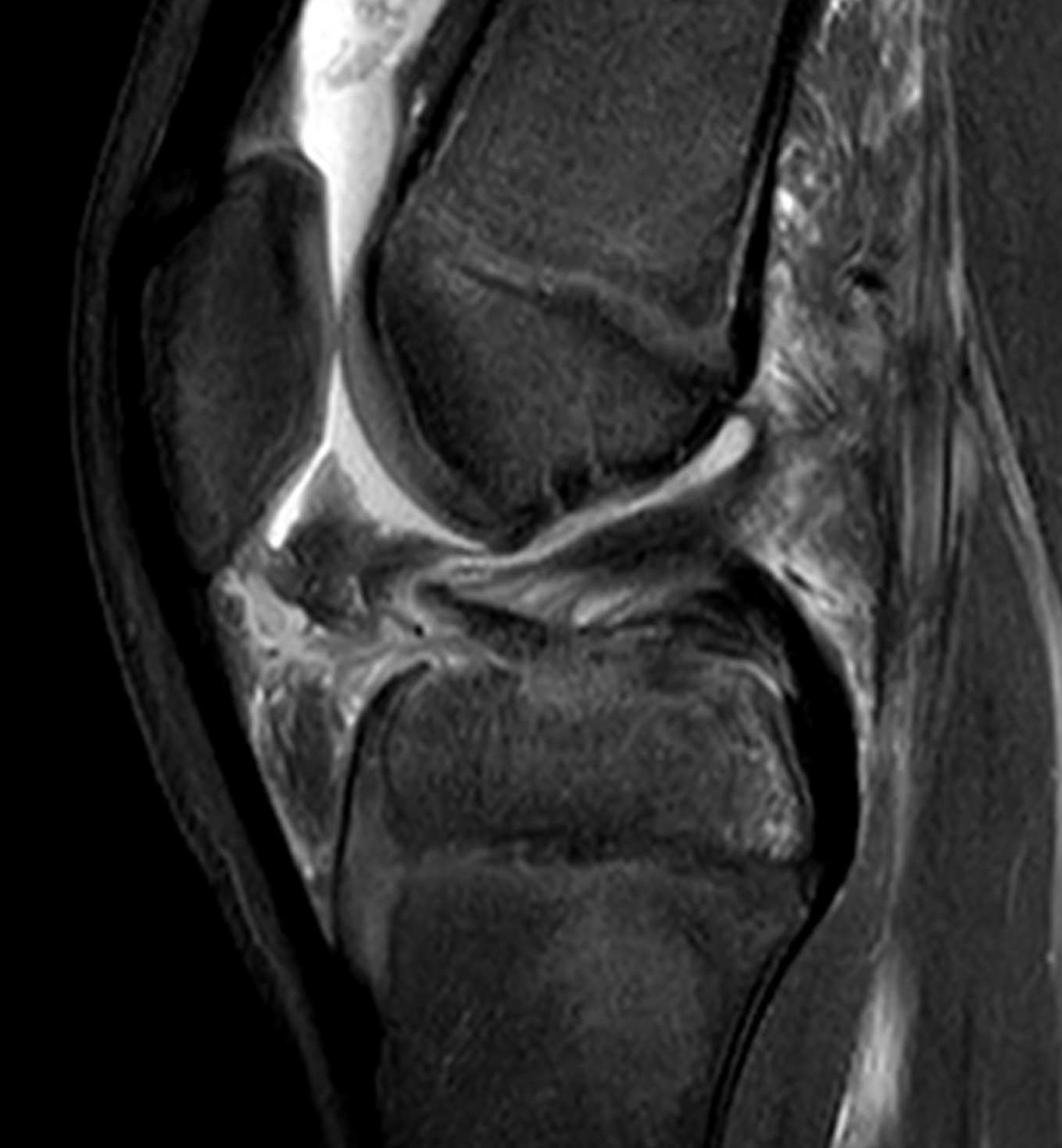 MRI ACL avulsion