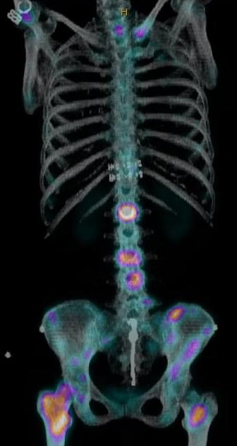 Bone scan mets breast cancer