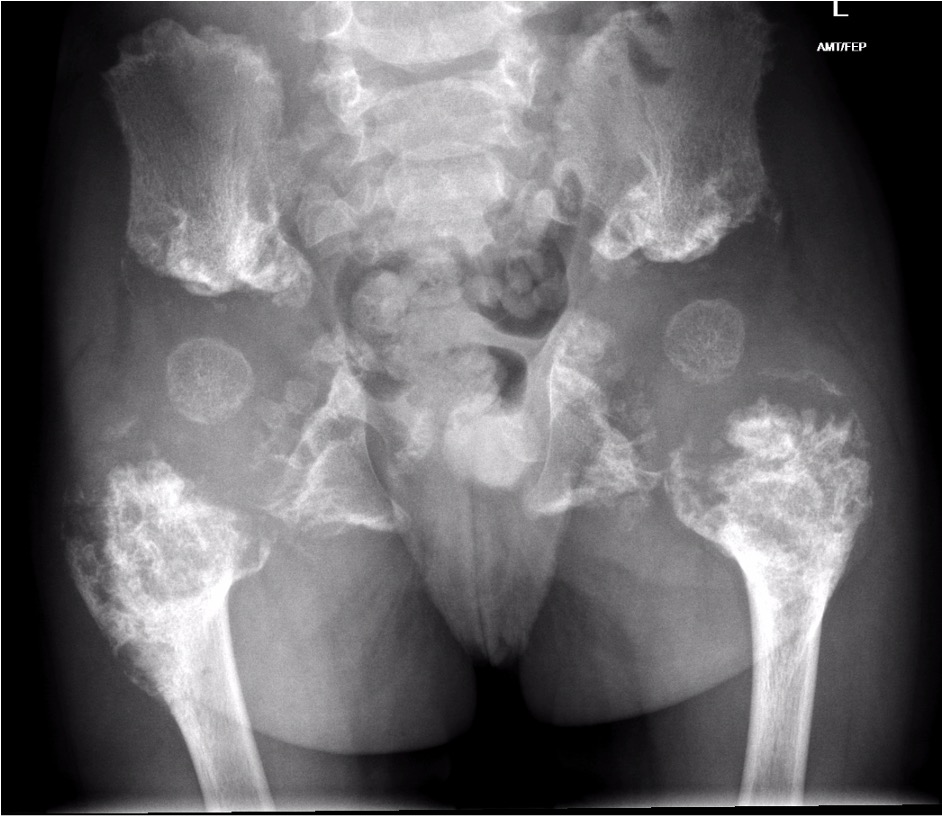 Metaphyseal chondrodysplasia