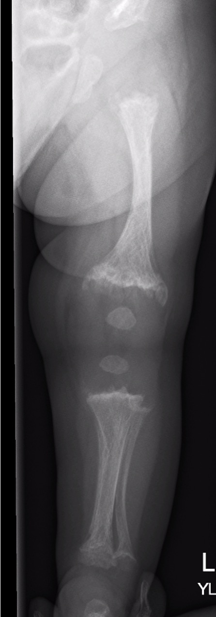 Metaphyseal chondrodysplasia hips