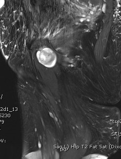 Neurofibroma 4