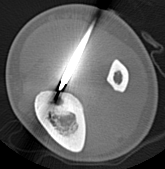 OO posterior tibia RFA