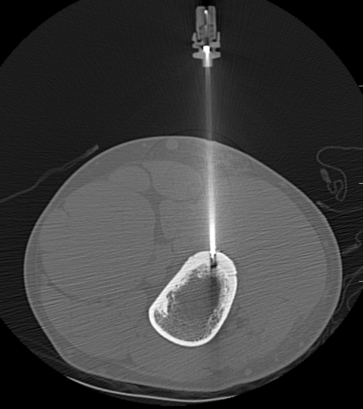 RF ablation femur