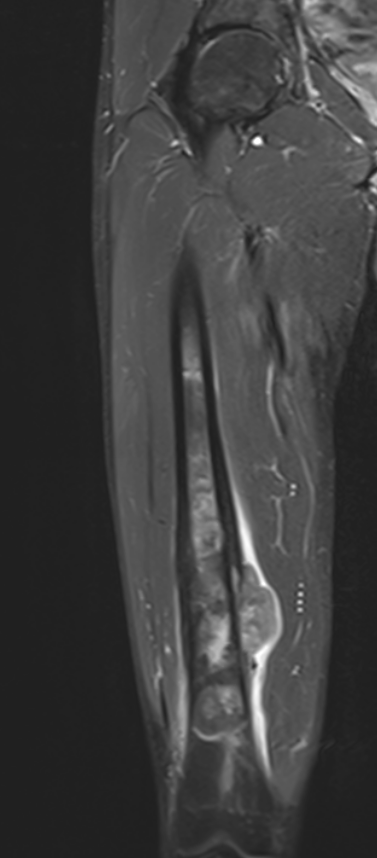 MRI OS Femur