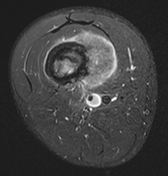 MRI OS Femur 3