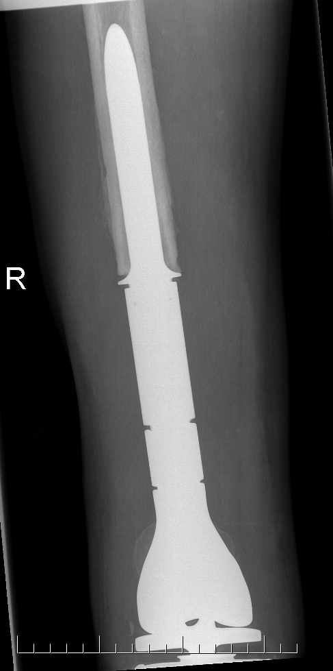 Femoral megaprosthesis 1