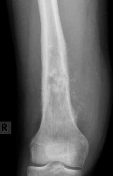 Osteosarcoma distal femur