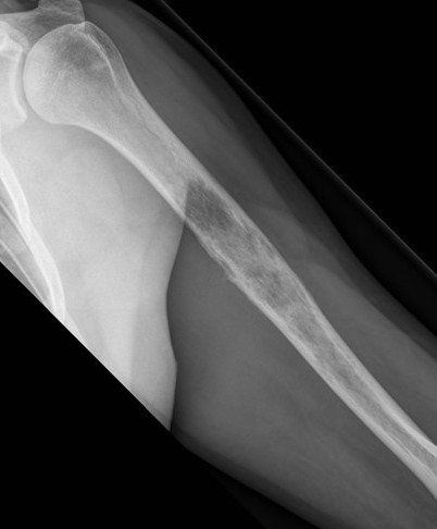 OS Humerus