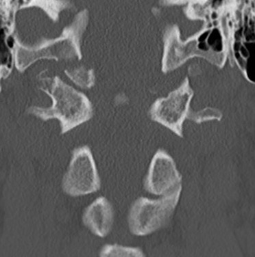 Occipitocondyle dis 2