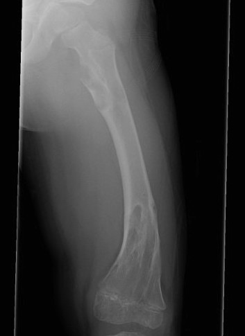 Olliers Femur