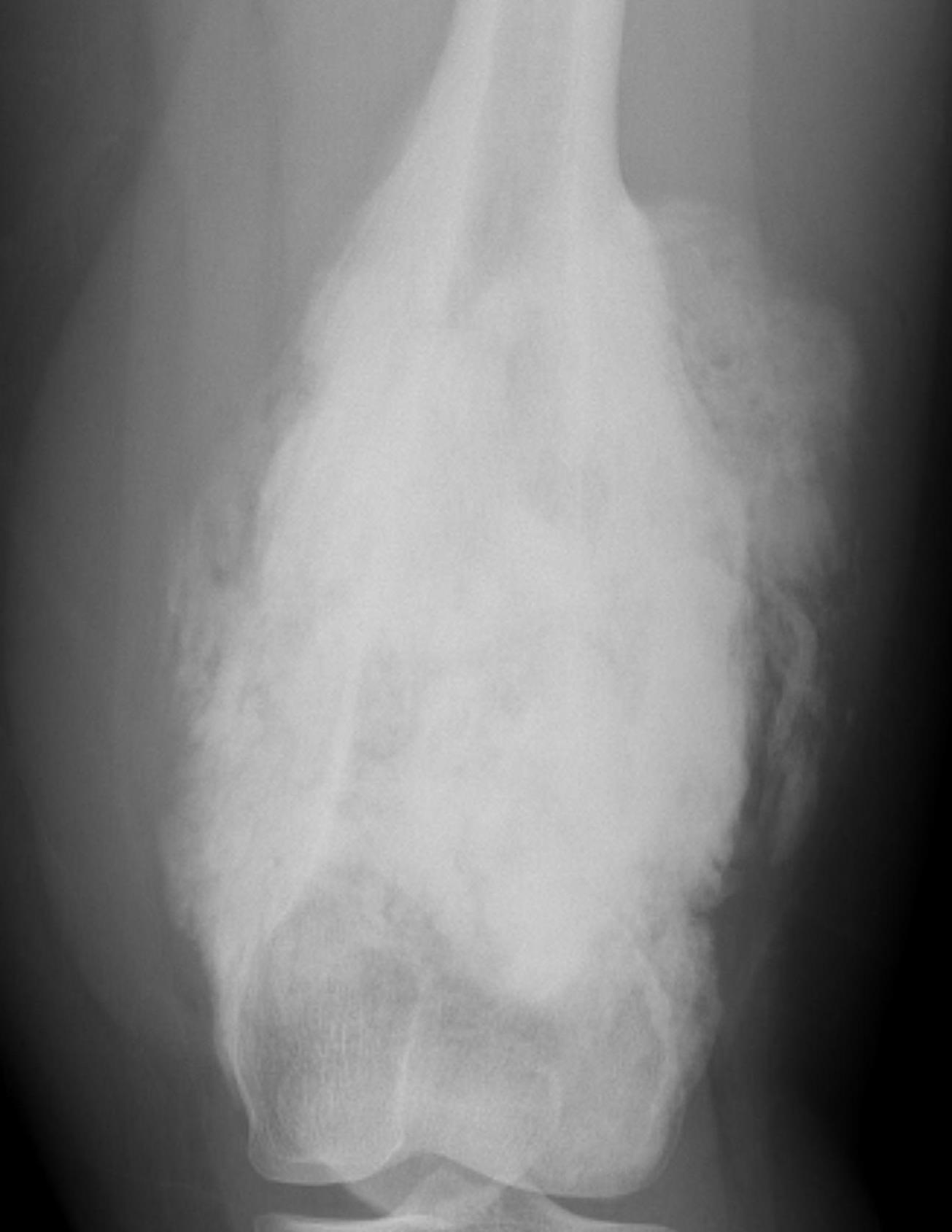 OS femur 1