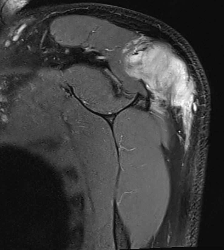 Desmoid MRI 2