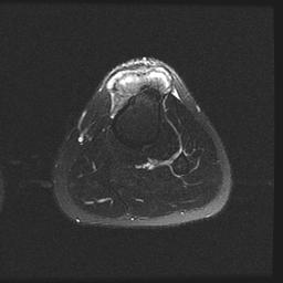 Parosteal OS tibia MRI