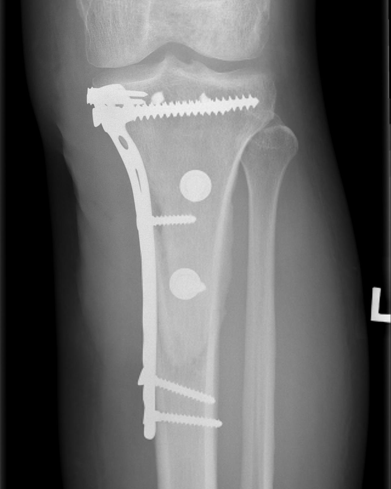 Parosteal OS tibia wide resection 1