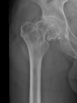 Hip CS path fracture 1