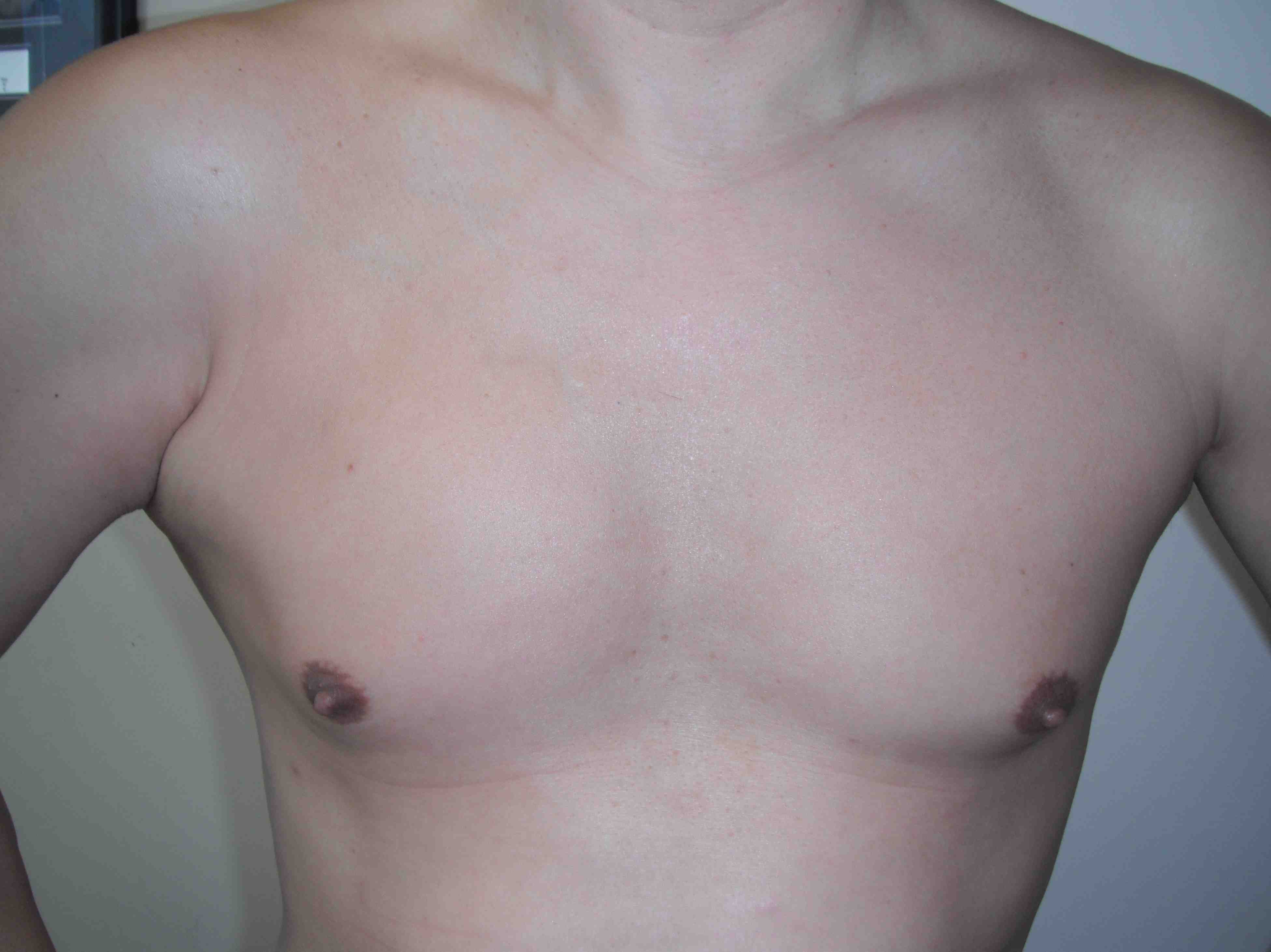 Pec Major Rupture