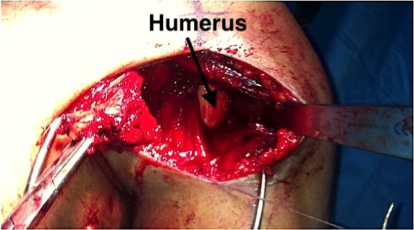 Pec major tear humerus