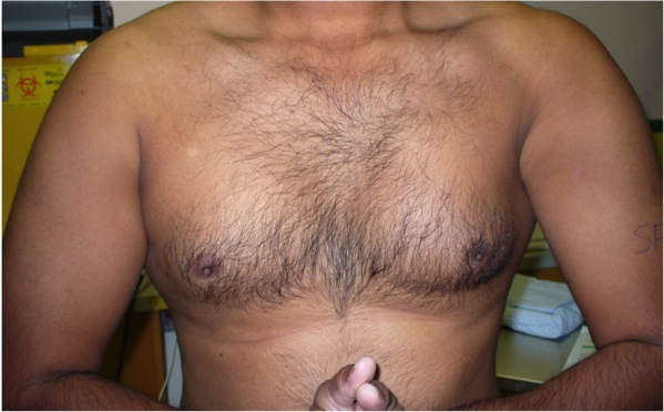 Pec major tear chronic