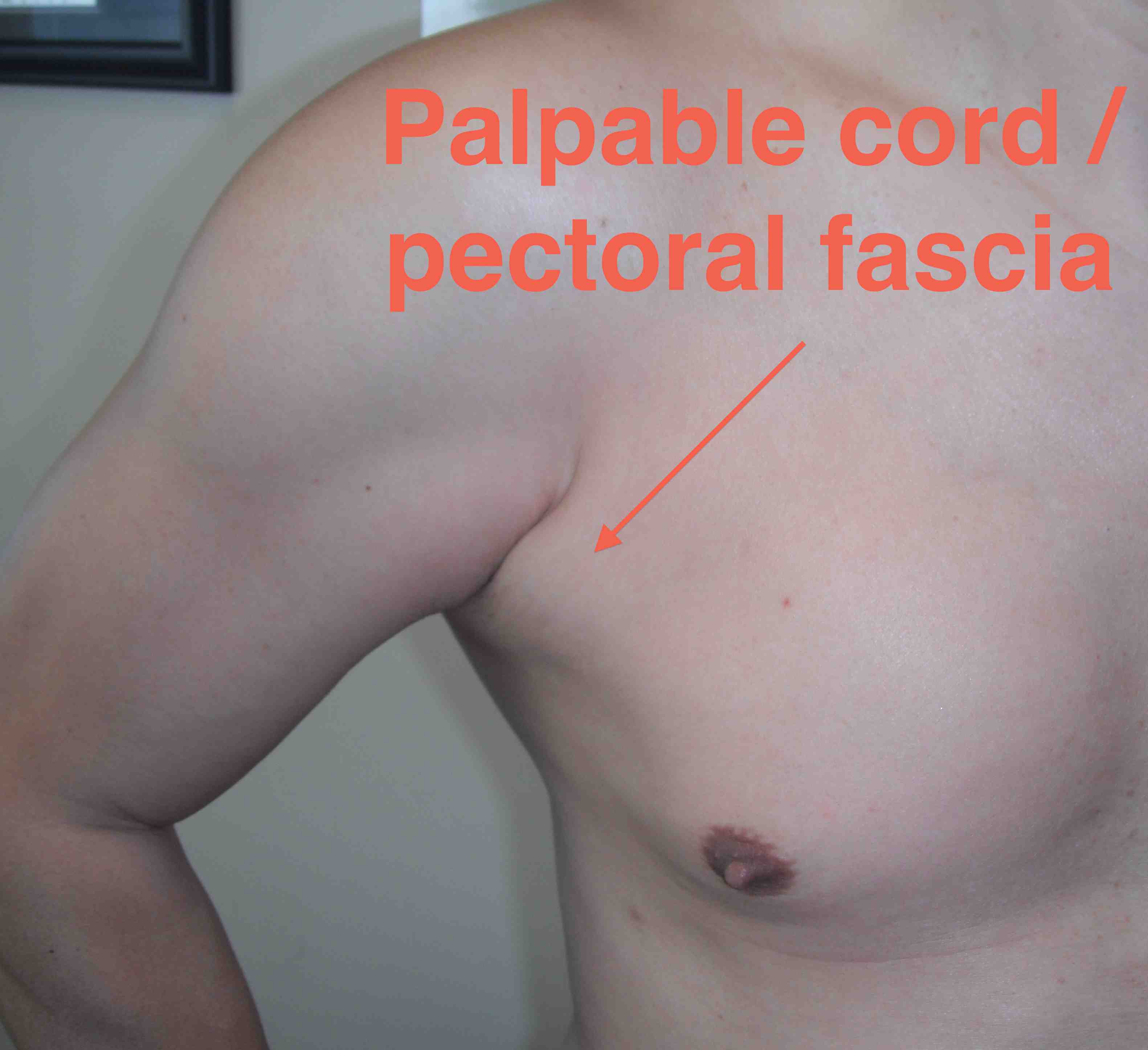 Pec major rupture palpable cord