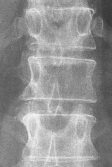 Pedicle loss