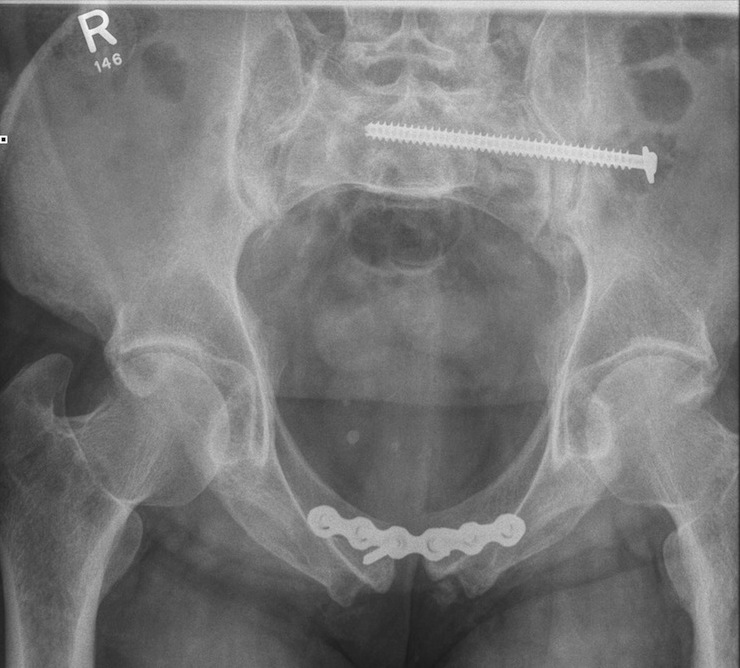 Pubic symphysis plate