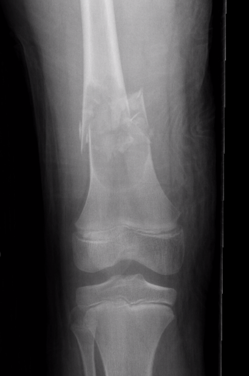 UBC femur fracture 2