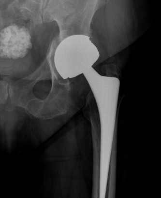 Metallosis xray