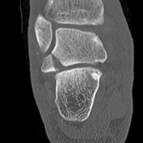 Lateral process talus