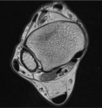 Peroneal dislocation