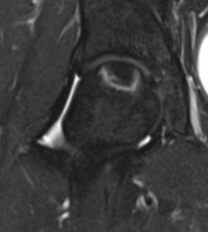 Hip AVN MRI