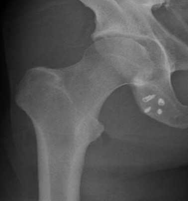 Proximal hamstring xray