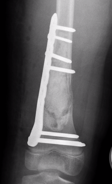 UBC femur ORIF 2