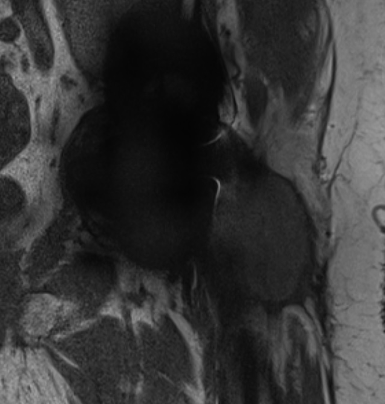 Metallosis MRI 