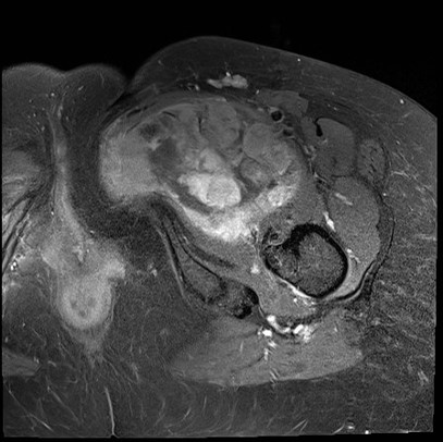 Pleomorphic sarcoma 3