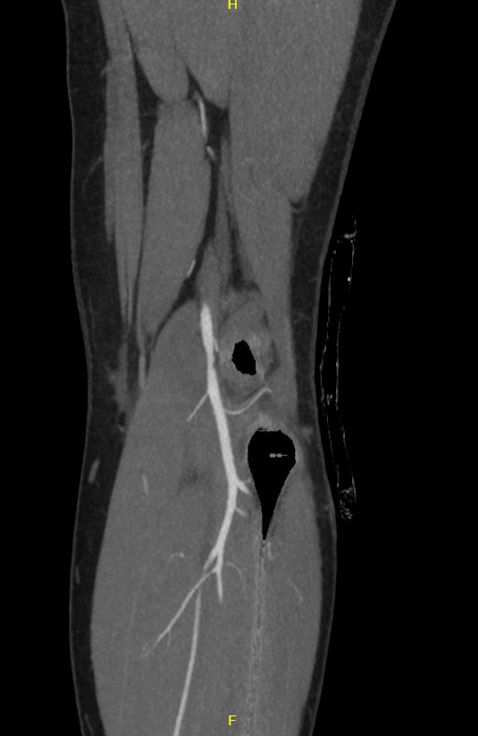 Popliteal artery stenosis