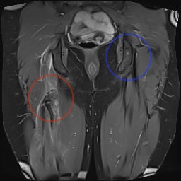 Prox HS MRI