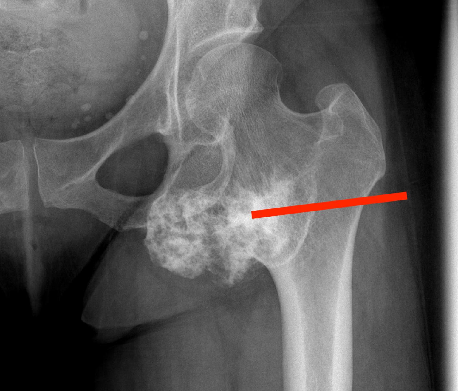 Proximal femur biopsy