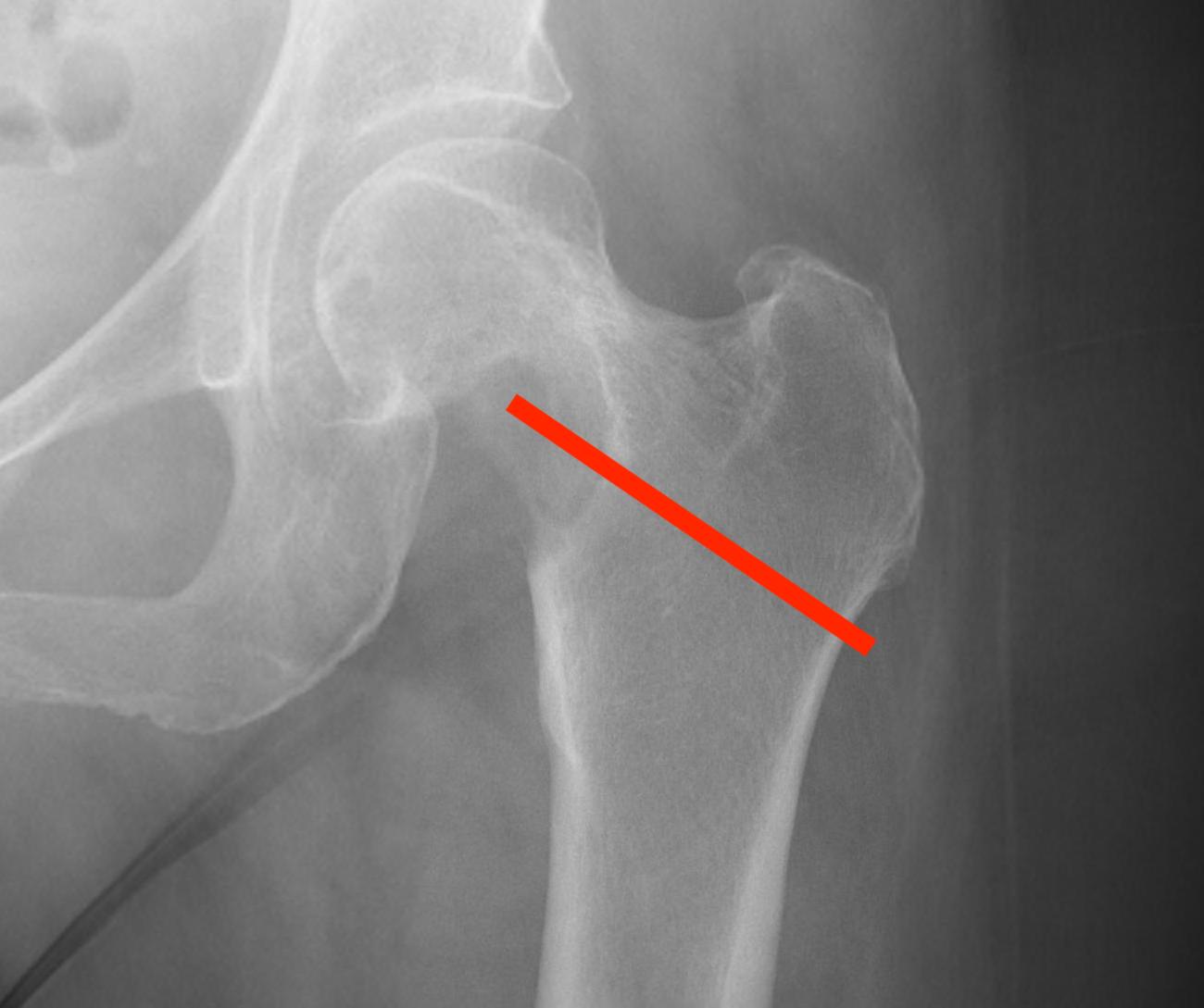 Proximal femur biopsy