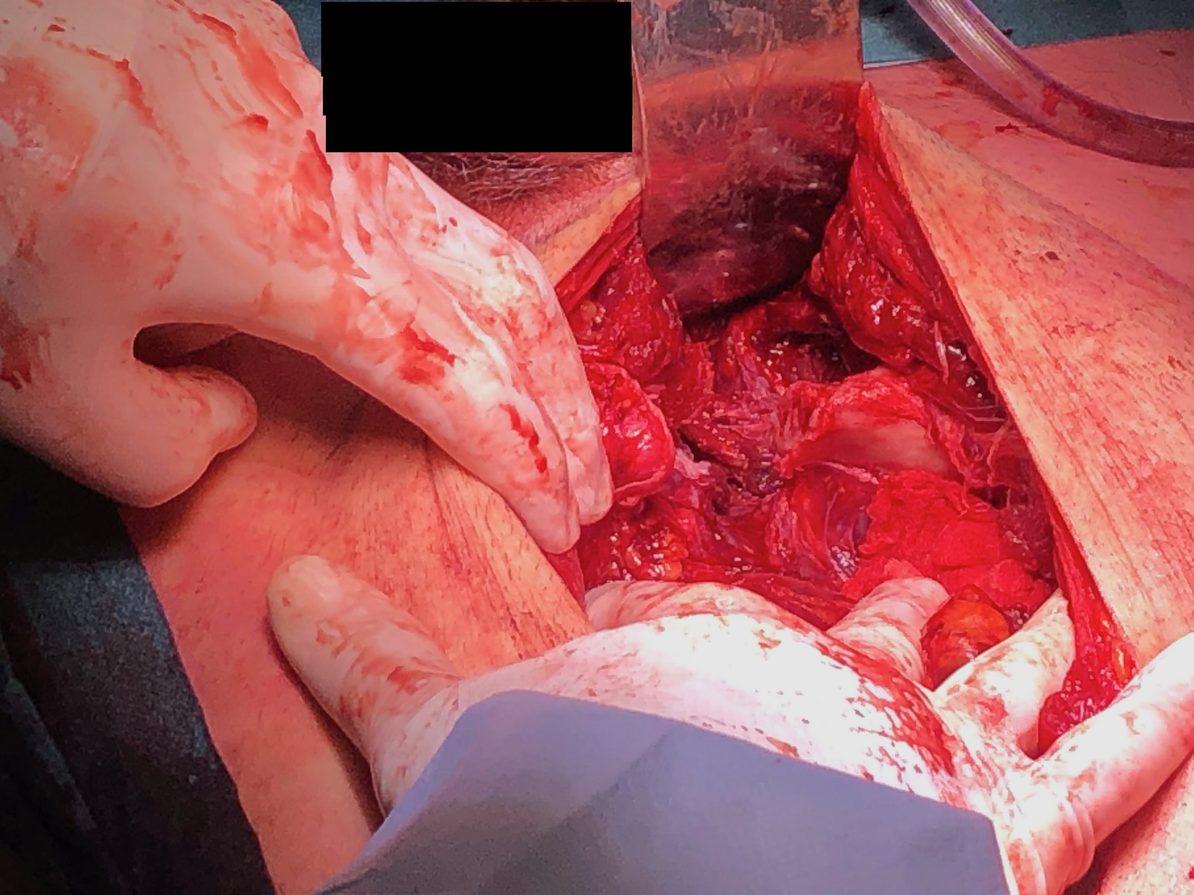 Retroperitoneal packing 1