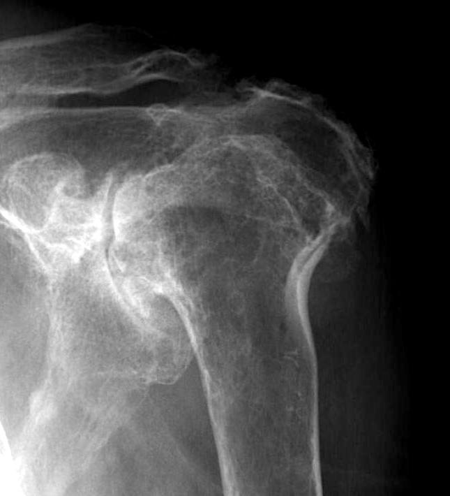 Destructive rheumatoid shoulder 2