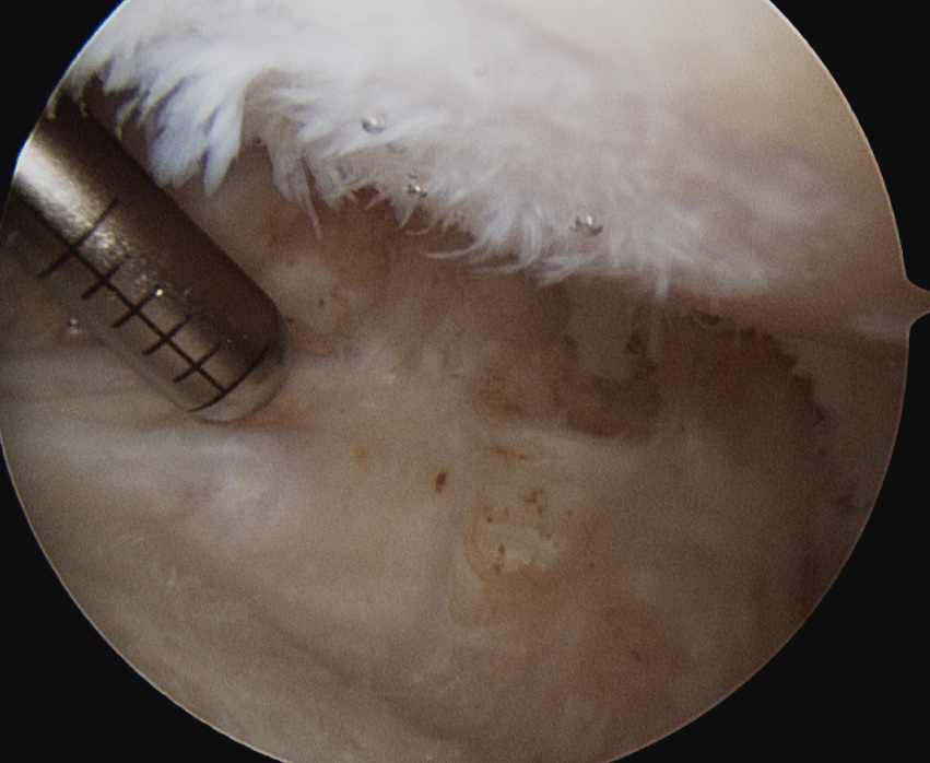 RA shoulder arthroscopy 3