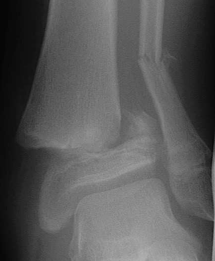 SH2 distal tibia 1