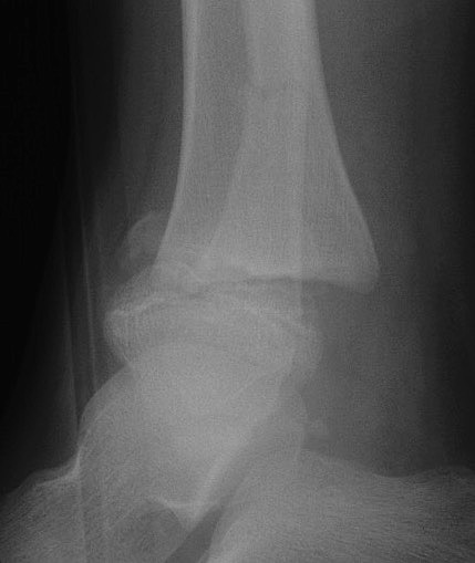 SH2 distal tibia 2