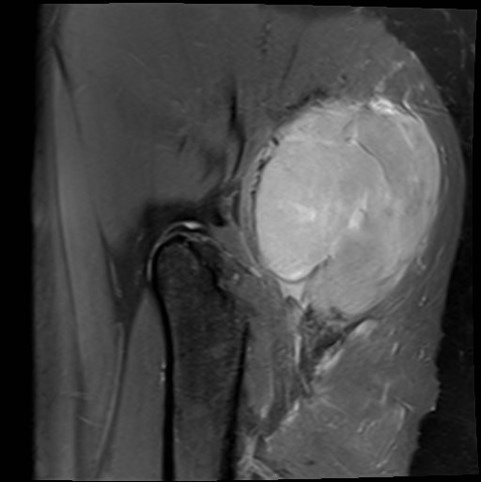 Sarcoma buttock