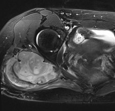 Sarcoma 5